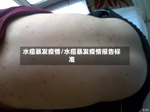 水痘暴发疫情/水痘暴发疫情报告标准-第1张图片