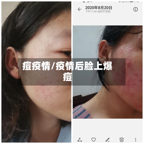 痘疫情/疫情后脸上爆痘-第1张图片