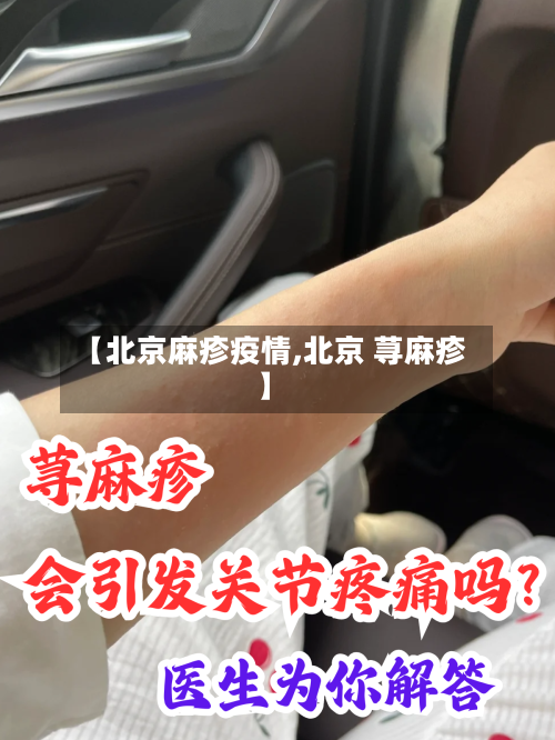 【北京麻疹疫情,北京 荨麻疹】-第1张图片